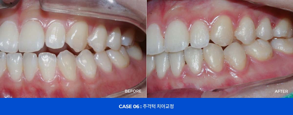 CASE 06 : 주걱턱 치아교정